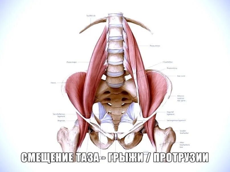 Смещен таз. Межпозвоночная грыжа таза. смещение таза.