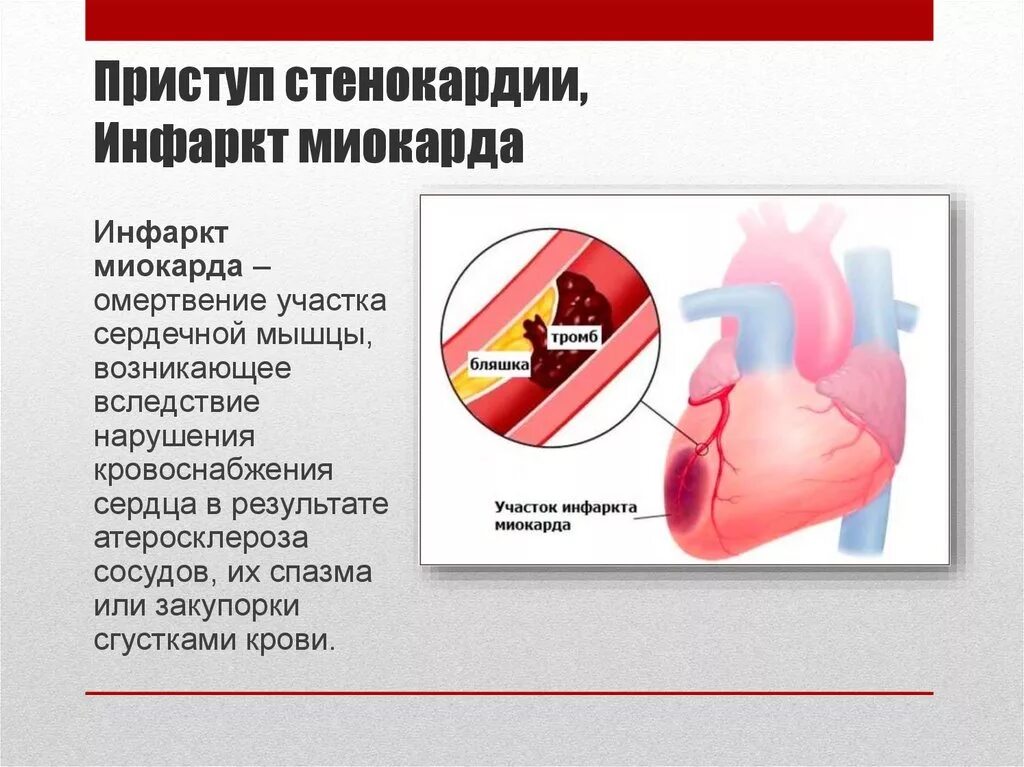 Ишемическая болезнь сердца стенокардия инфаркт миокарда. Форма сердца при инфаркте.