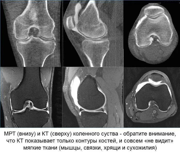 Гонартроз мрт. Деформирующий остеоартроз кт. магнитно-резонансная томография коленного сустава. мрт коленного сустава норма. остеоартрит коленного сустава мрт.