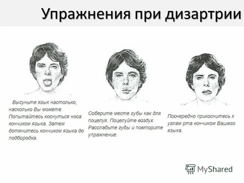 Нарушение речи после инсульта