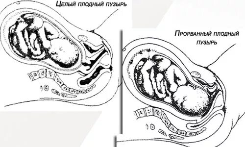 Плодный пузырь у беременной.