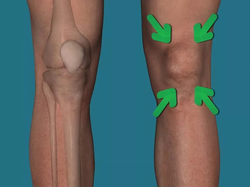 Колено стучит. Подколенная Вена варикоз. Смещение коленной чашечки. Локотная чашечка у человека.
