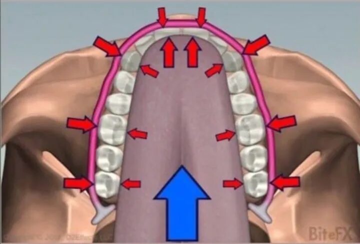 Как держать язык во рту. Вмятины на Верхнем небе. Правильное расположение языка. Правильная позиция языка. Аппарат для расширения верхней челюсти.