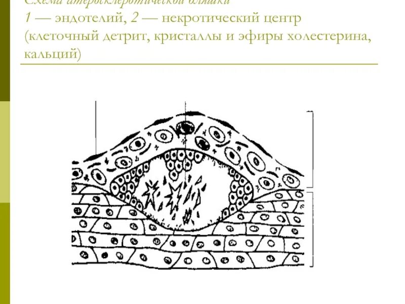 Дифтеритический колит макропрепарат. Изъязвление атеросклеротической бляшки. Перевариваемая клетчатка в кале. Дифтеритическая ангина микропрепарат. Схема атеросклеротической бляшки.