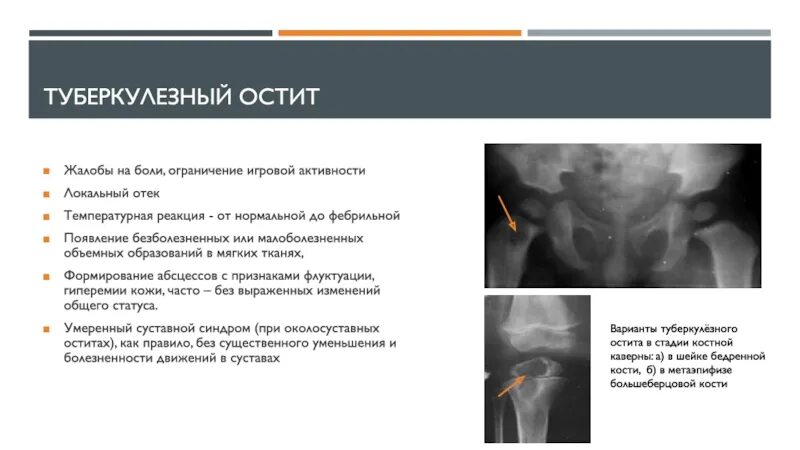 Первичный туберкулезный остит. Туберкулезный остит чаще всего возникает. Туберкулез кости первичный остит. Локальное опухоль