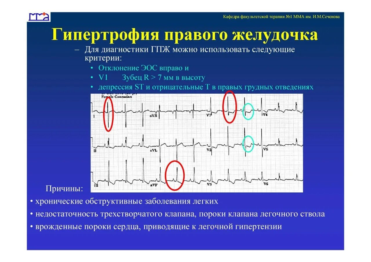 Причины гипертрофии левого желудочка. Гипертрофия миокарда правого желудочка. Гипертрофия правого желудочка на ЭКГ. Признаки гипертрофии правого желудочка на ЭКГ. Гипертрофия желудочков на ЭКГ.