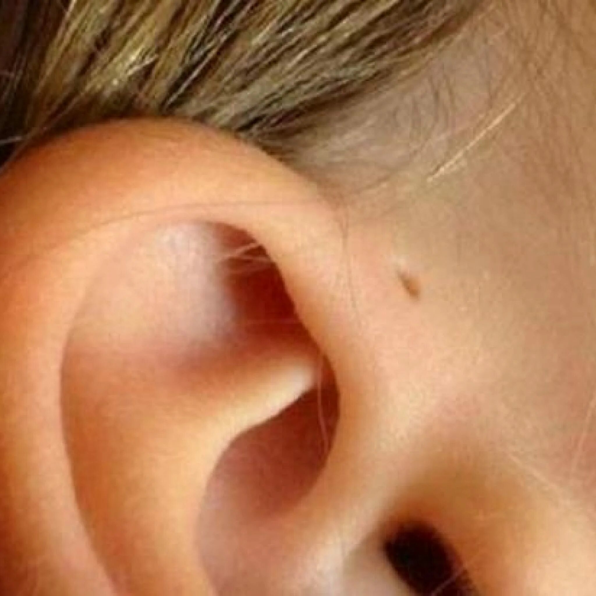 Козелок уха у ребенка