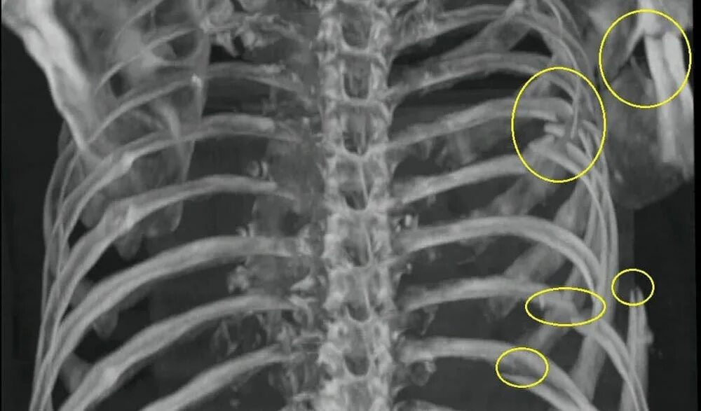 Рентген грудной клетки перелом ребер. Рентген ребер грудной клетки. Рентгеновские снимки переломов ребер. Перелом ребер рентгенограмма. Трещина в ребре что делать