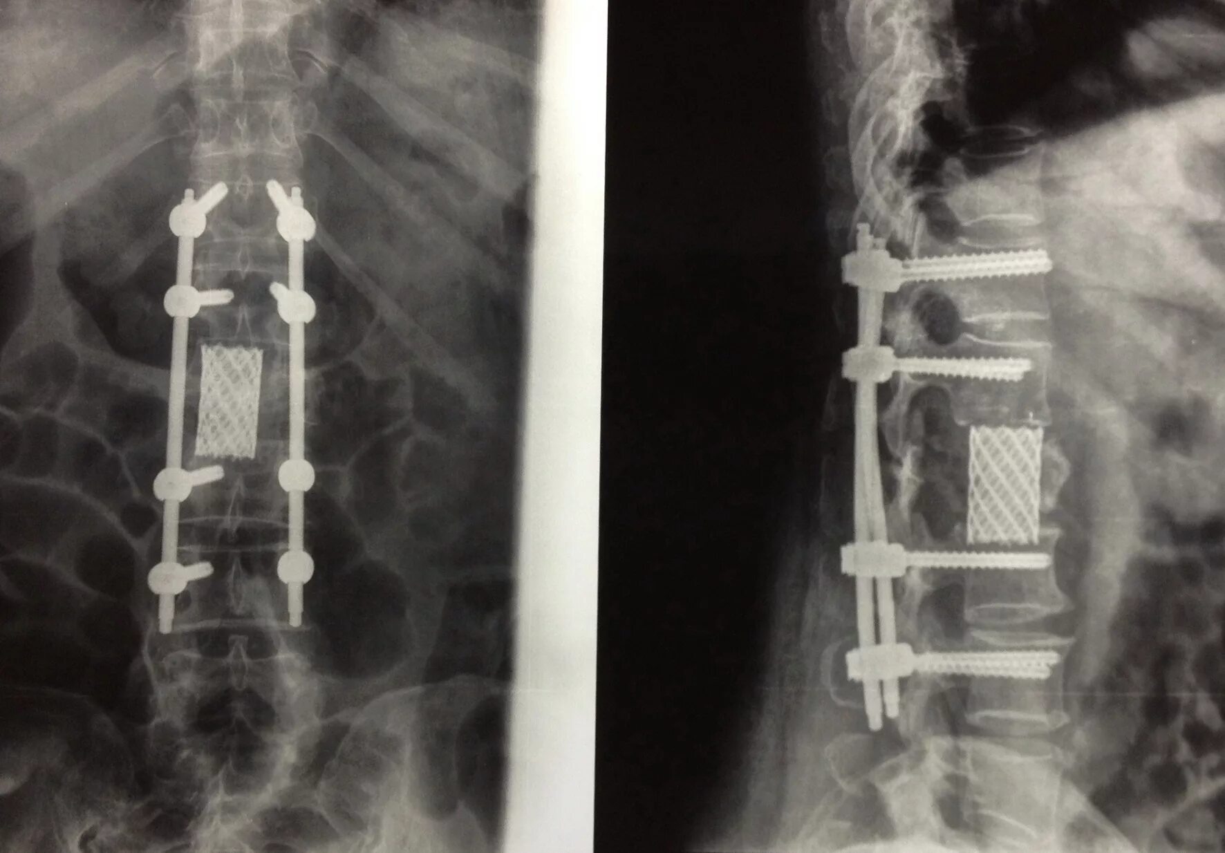 Оперативное лечение позвоночника. Передний спондилодез l5. Спондилодез шейного отдела рентген. Остеосинтез поясничного отдела позвоночника.