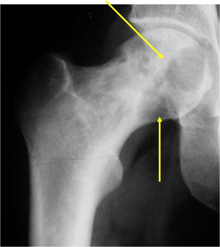 Хондрома бедренной кости. Энхондрома плечевой кости рентген. Хондросаркома бедренной кости рентген. Отек шейки бедра