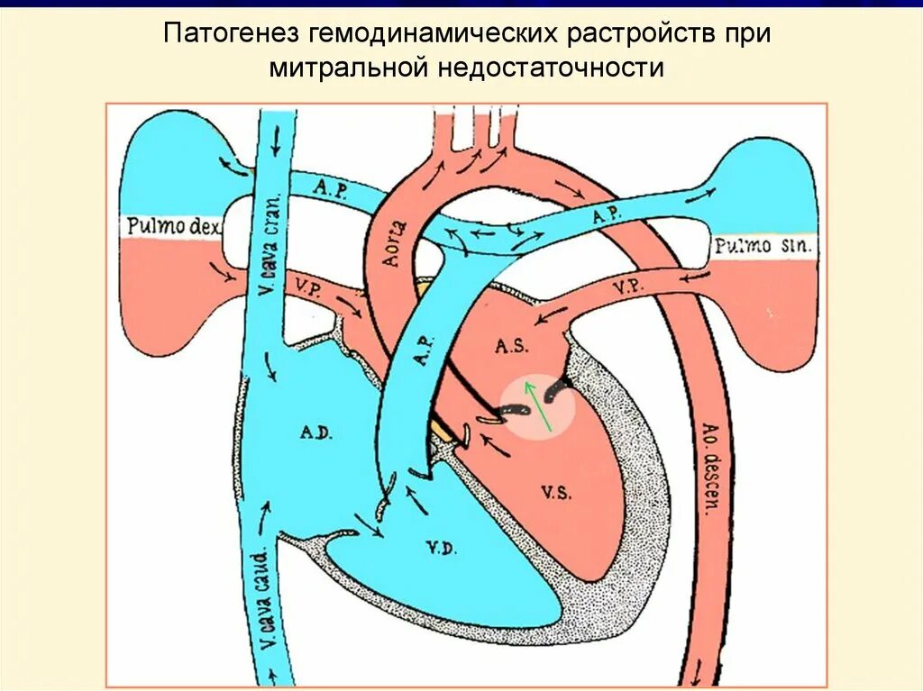 Аортальный стеноз гемодинамика схема. Приобретенные пороки сердца схема гемодинамики. Митральная недостаточность патогенез гемодинамики. Недостаточность аортального клапана патогенез гемодинамики.