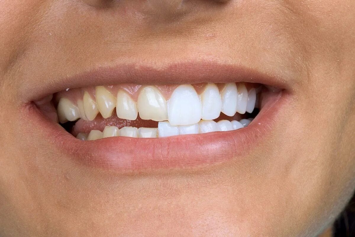 Почему зубы отличаются между собой. Виниры цельнокерамические Emax. Композитные виниры COMPONEER. Виниры люминиры компониры.