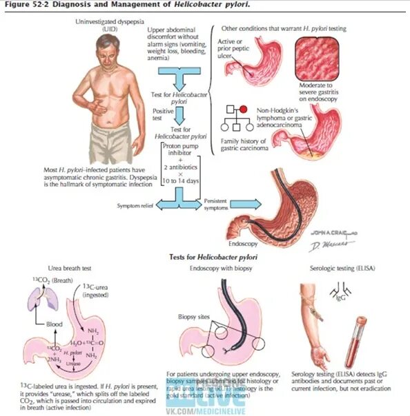 Признаки хеликобактер в желудке. Язва 12 перстной кишки вызванная хеликобактер пилори. Хеликобактер в 12 перстной кишке. Желудок пораженный хеликобактер пилори.