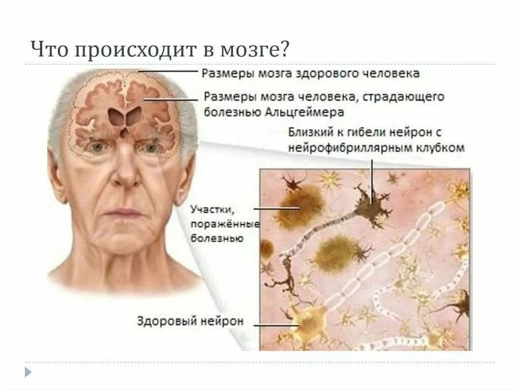 Болезнь Альцгеймера Нейроны. Нейрофибриллярные клубки болезнь Альцгеймера.