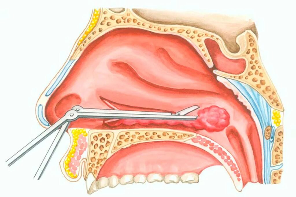 Вазотомия лазером. Конхотомия нижних носовых раковин. Подслизистая вазотомия носовых. Вазотомия носовых раковин. Вазомоторный ринит эндоскопия.