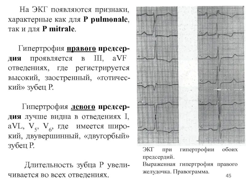Гипертрофия желудочков на ЭКГ. Гипертрофия п п ЭКГ. Гипертрофия правого желудочка на ЭКГ. Зубец р pulmonale на ЭКГ. Перегрузка на экг что это