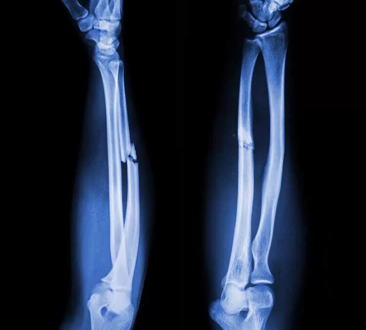 Смещение кости на руке без перелома. Рентген перелома кости предплечья. Перелом диафиза лучевой кости рентген. Перелом диафиза локтевой кости рентген. Изолированный перелом диафиза локтевой кости.