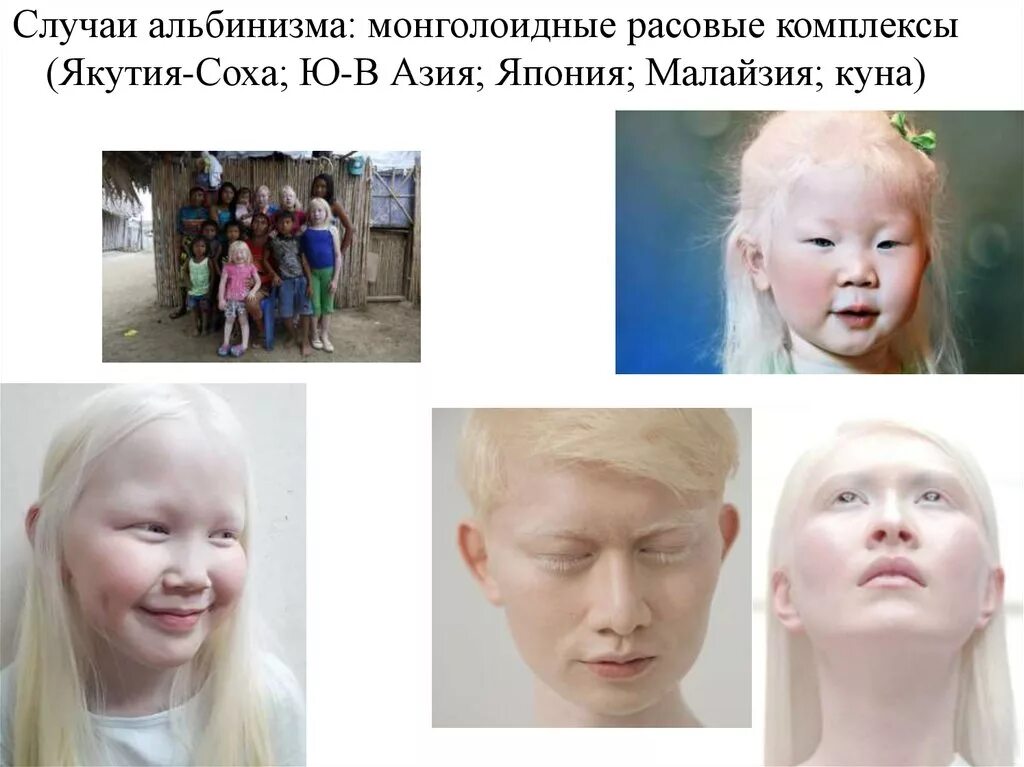 Расовый комплекс. Монголоидный расизм. Монголоидный Тип волос. Монголоидные черты лица. Альбинизмом страдают