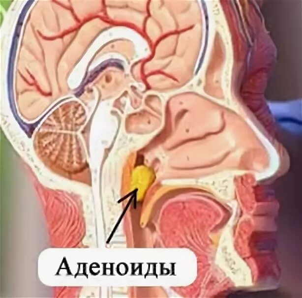 Аденоидные вегетации 1. Аденоидные вегетации 2 степени. Аденоидные вегетации 3 степени. Аденоидные вегетации 1 степени.