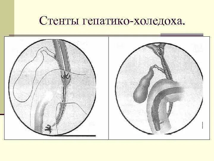 Стент желчного протока