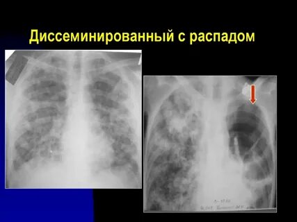 Фаза распада легких туберкулез