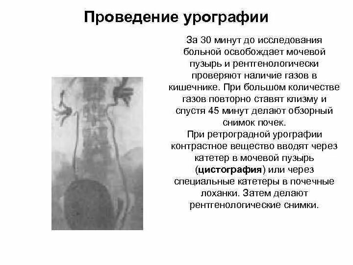 Как делается урография. Внутривенная урография методика проведения. экскреторная урография методика проведения. экскреторная урография методика выполнения. техника проведения экскреторной урографии.