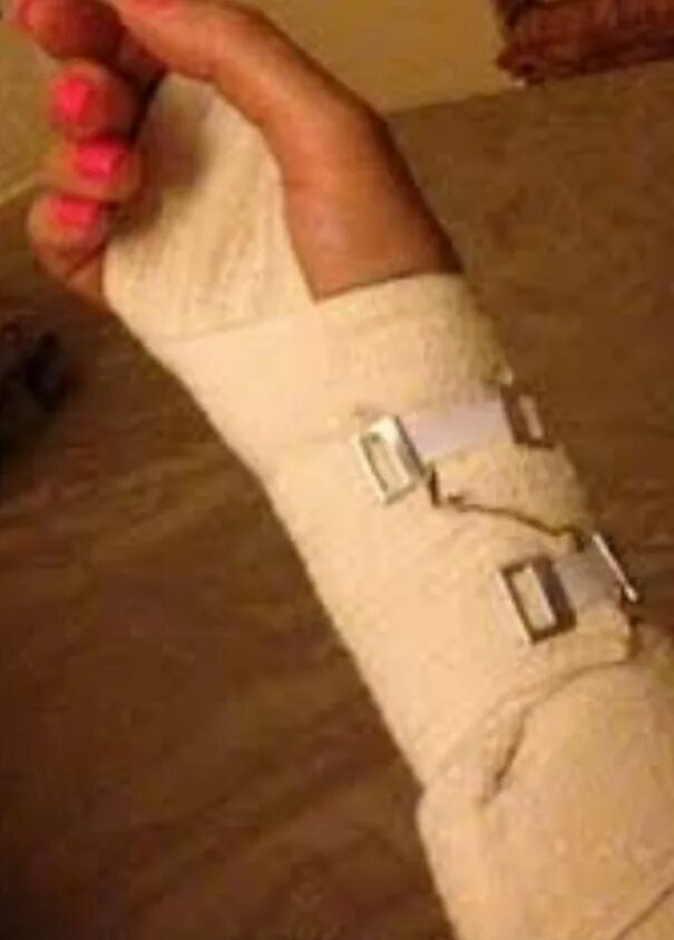 Гипс при переломе запястья. Перелом лучевой кости гипсование. Вывих пальца гипс. Вывих пальца гипс. Лангетка при переломе лучевой кости.