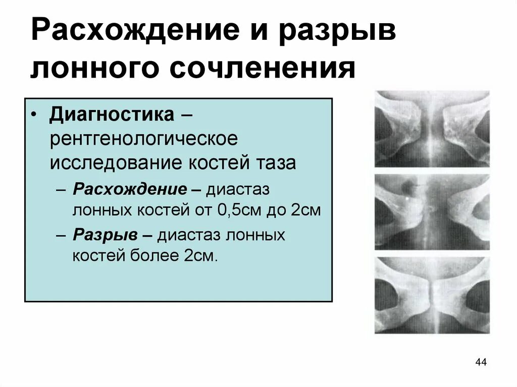 Разрыв лонного сочленения рентген степени. Симфизиопатия 2 степени при беременности. Лонное сочленение норма и расхождение. УЗИ костей лонного сочленения при беременности.