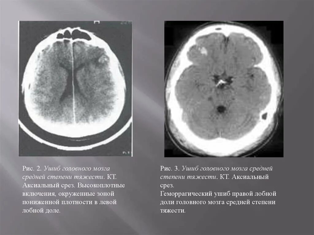 Мрт при сотрясении. Ушиб головного мозга легкой степени тяжести кт. Ушиб мозга средней степени. Ушиб головного мозга кт степени.