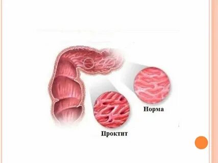 Лечение проктита прямой кишки препараты