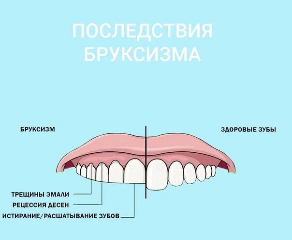 Сильно сжатые зубы. Бруксизм скрежетание зубами.