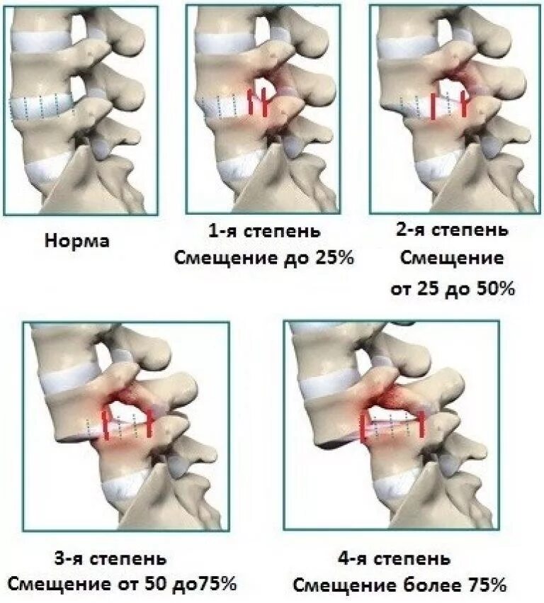 Ретролистез позвонка шейного отдела 1 степени что. Ретролистез l2 2.5 мм. Ретролистез позвонка l4 кзади что это. Ретролистез с5 на 2мм. Операция смещение позвоночника
