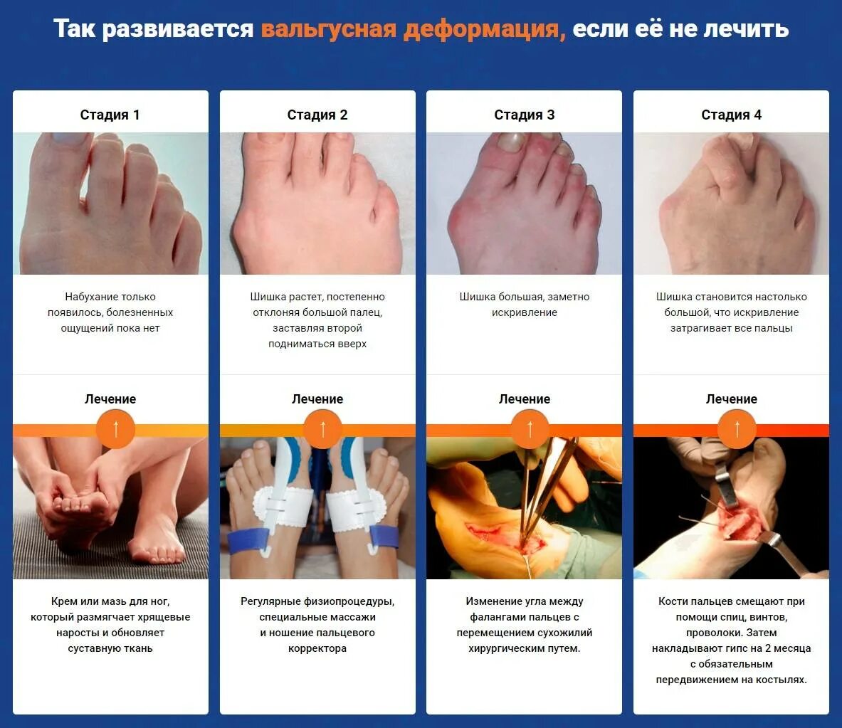 Деформация стопы у взрослых лечение гимнастика вальгусная. Лфк при деформации вальгусной деформации стопы. упражнения для вальгусной деформации 1 пальца стопы. лфк при вальгусная деформация большого пальца стопы. упражнения лфк для вальгусной деформации стопы.