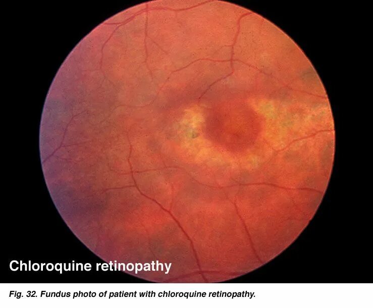 Прима макула. Альбуминурическая ретинопатия. Солнечная ретинопатия. Радиационная ретинопатия.