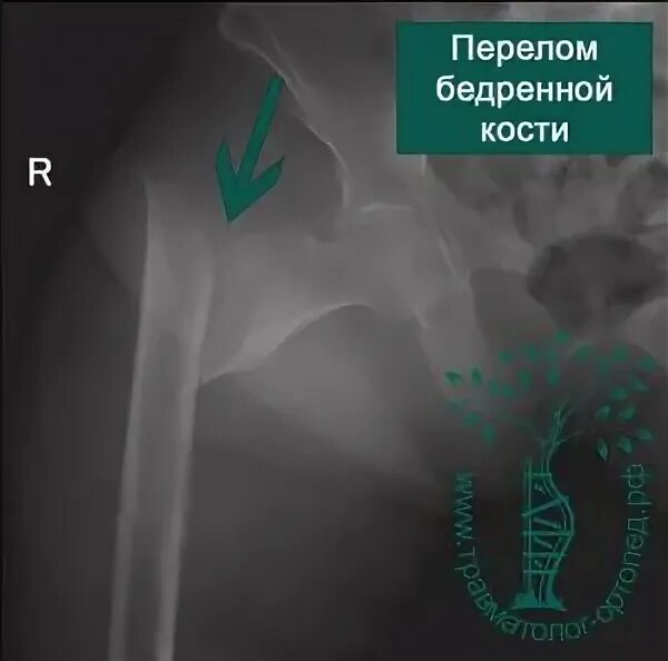 Перелом бедра лечение без операции