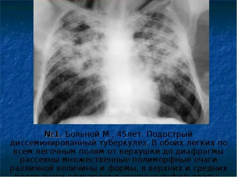В обеих репликах. Подострый диссеминированный туберкулез рентген. Милиарный диссеминированный туберкулез. Диссеминированный туберкулез на рентгенограмме. Диссеминированный туберкулез легких рентген.