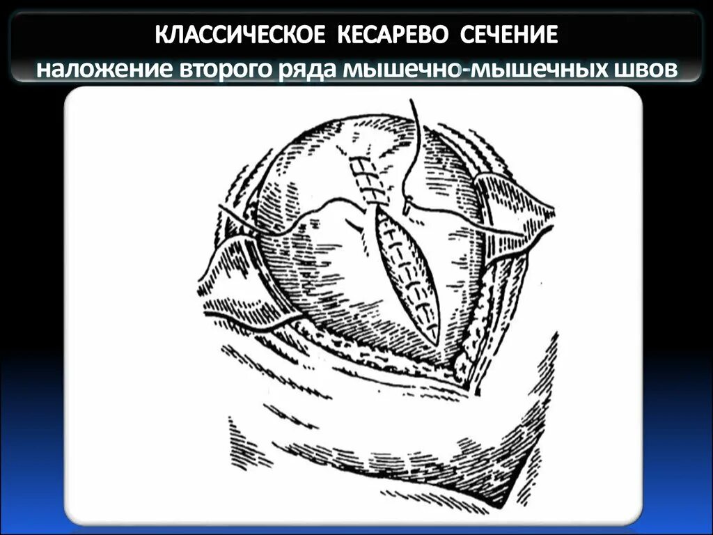 Техника кесарева сечения. Экстраперитонеальное кесарево сечение. Корпоральное и истмико-корпоральное. Ретровезикальное кесарево сечение. Истмико-корпоральное кесарево сечение показания.