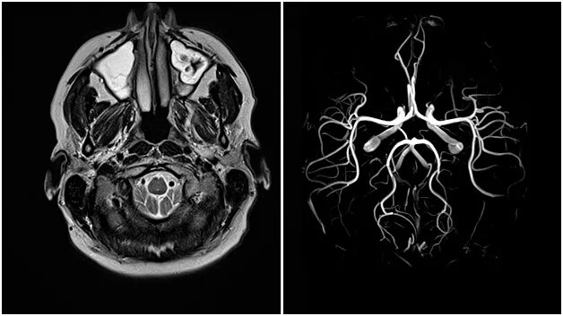 Венография головного мозга. Мрт ангиография сосудов головного. Кт ангиография сосудов головного мозга с контрастом. Магнитно-резонансная ангиография артерий головного мозга. Магнитно-резонансная венография головного мозга.