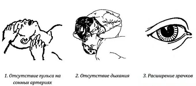 Зрачки и пульс проверить. Признак клинической смерти мидриаз. реакция зрачка при клинической смерти и биологической. признаки клинической смерти отсутствие пульса на сонной артерии. признаки клинической смерти рисунок.