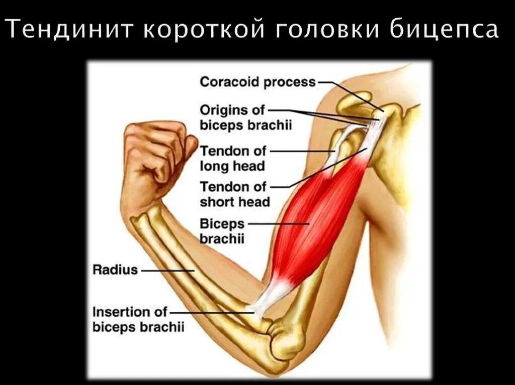 Разрыв дистального сухожилия бицепса. Тендинит сухожилия двуглавой мышцы. тендинит короткой головки бицепса. сухожилие двуглавой мышцы плеча. сухожилие длинной головки двуглавой мышцы.
