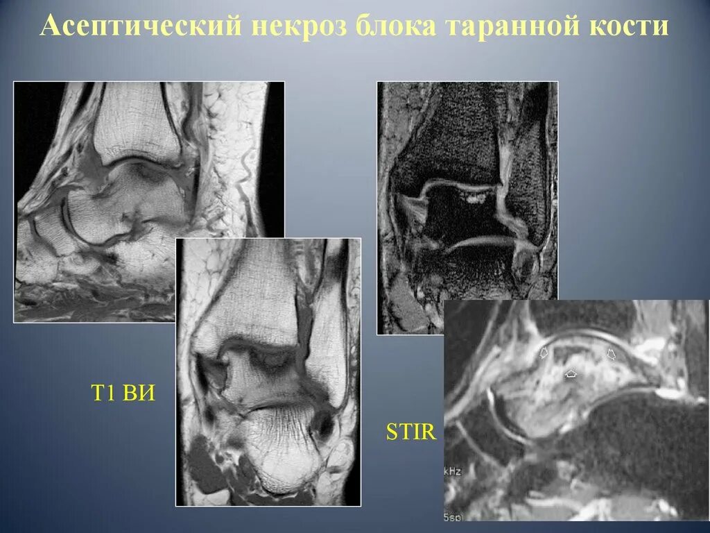 Асептический некроз таранной кости голеностопного сустава мрт. Асептический некроз таранной кости мрт. Таранная кость асептический некроз. Асептический некроз таранной кости кт.