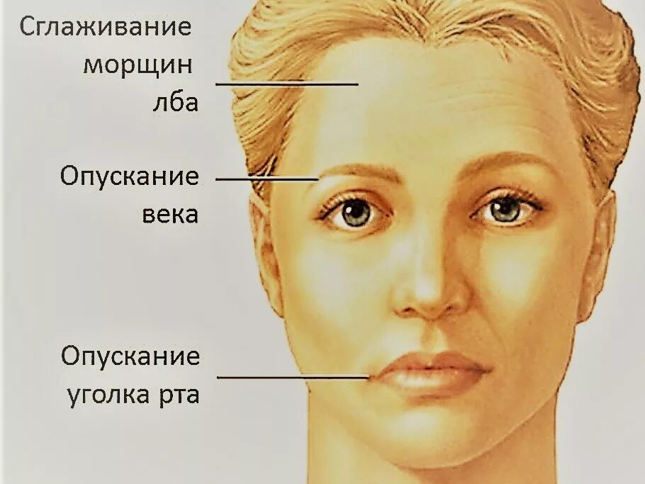 Рот опущен вниз. Нейропатии лицевого нерва. Паралич тройничного нерва лица. Лицевой неврит.