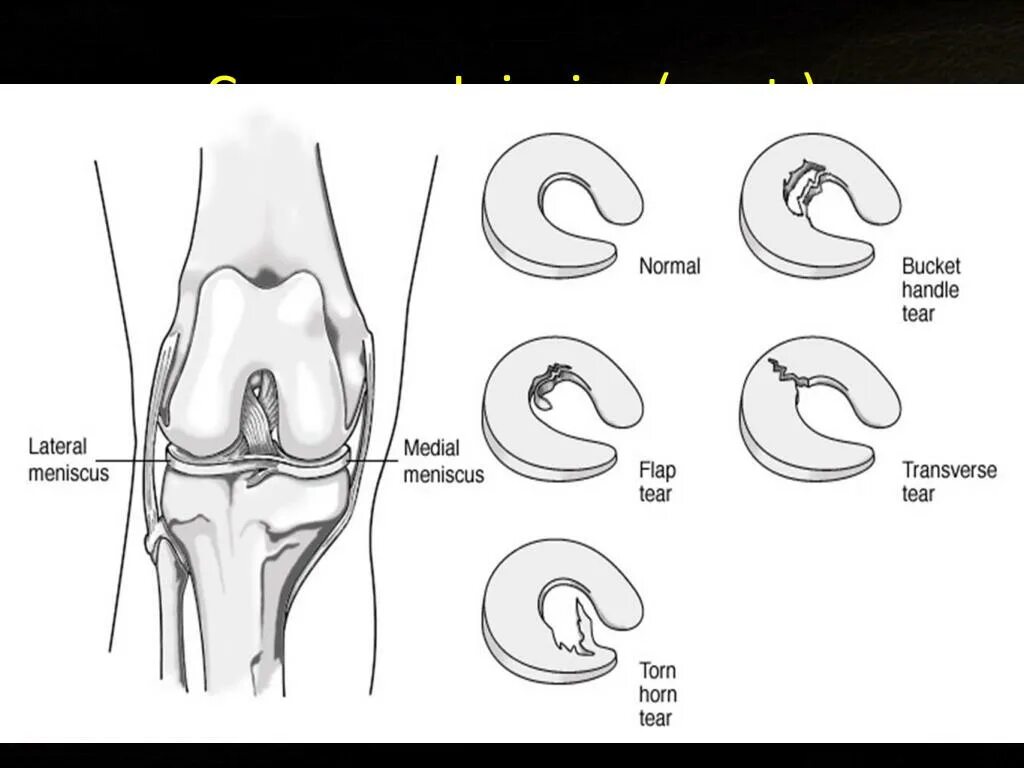 Типы разрывов мениска. Повреждение мениска коленного сустава классификация. Stoller классификация повреждения менисков. Разрыв мениска коленного сустава классификация Stoller. Разрыв латерального мениска по типу ручки лейки мрт.