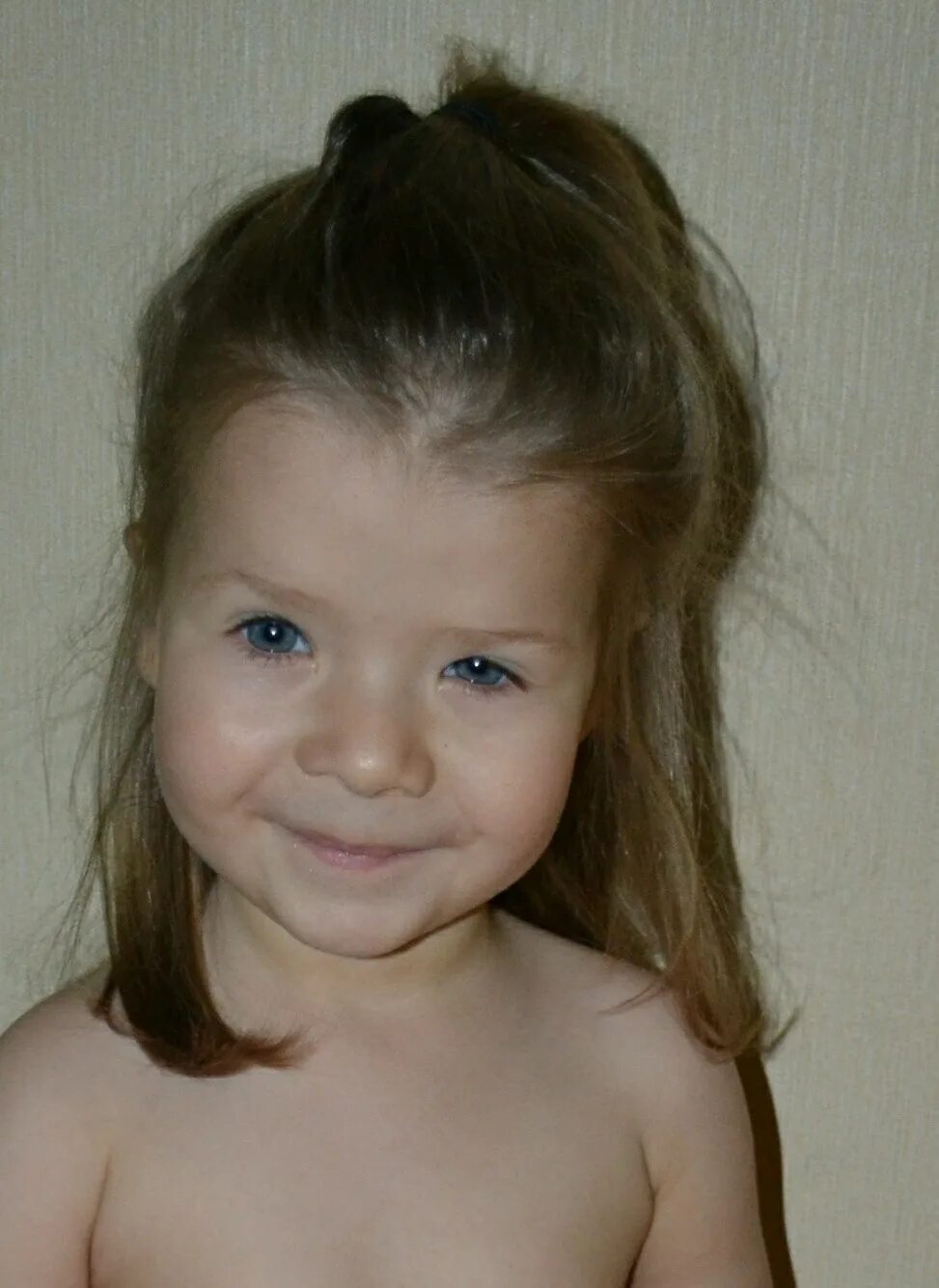 Микроделеция. Микроделеция