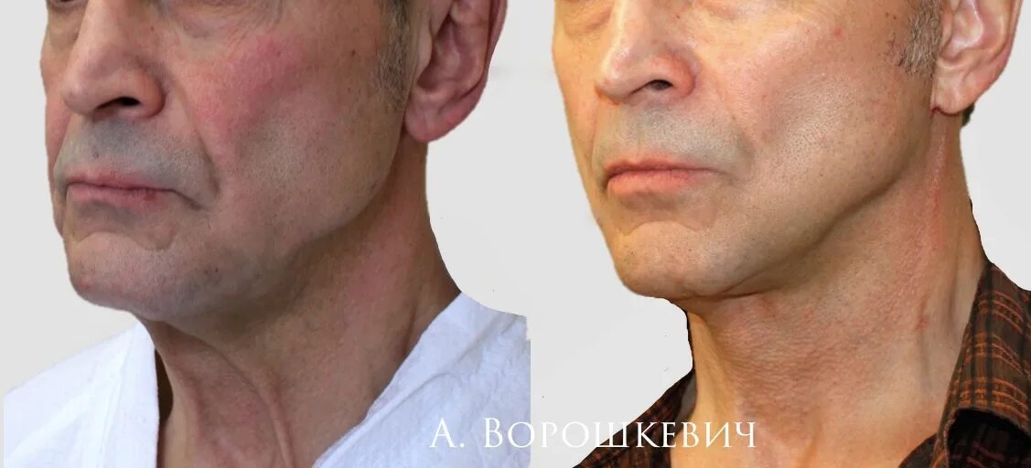 Спейс пластика в прямом эфире Доктор Росс