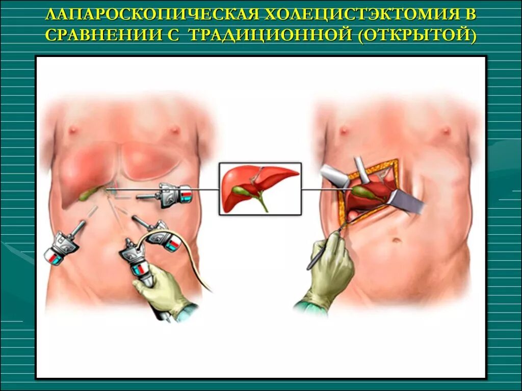 Месяц после холецистэктомии. Лапаротомия холецистэктомия. Холецистэктомия желчного пузыря лапароскопическая. ЖКБ лапароскопическая холецистэктомия. Холецистит лапароскопическая операция.