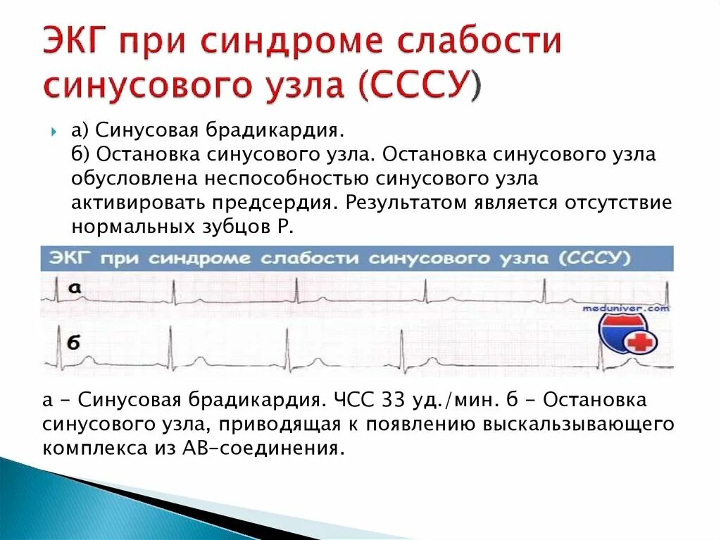 Слабость синусового узла код по мкб 10. Синдром слабости синусового узла. синдром слабости синусового узла экг. остановка синусового узла на экг. синдром слабости синусового узла классификация.