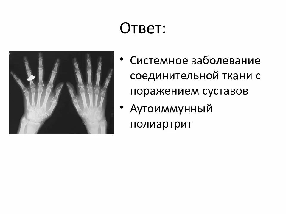 Смешанные заболевания соединительной. Болезни соединительной ткани ревматоидный артрит. Склеродермия (аутоиммунное заболевание соединительной ткани) что это. Смешанные системные заболевания соединительной ткани. Системных заболеваний соединительной ткани рентген.