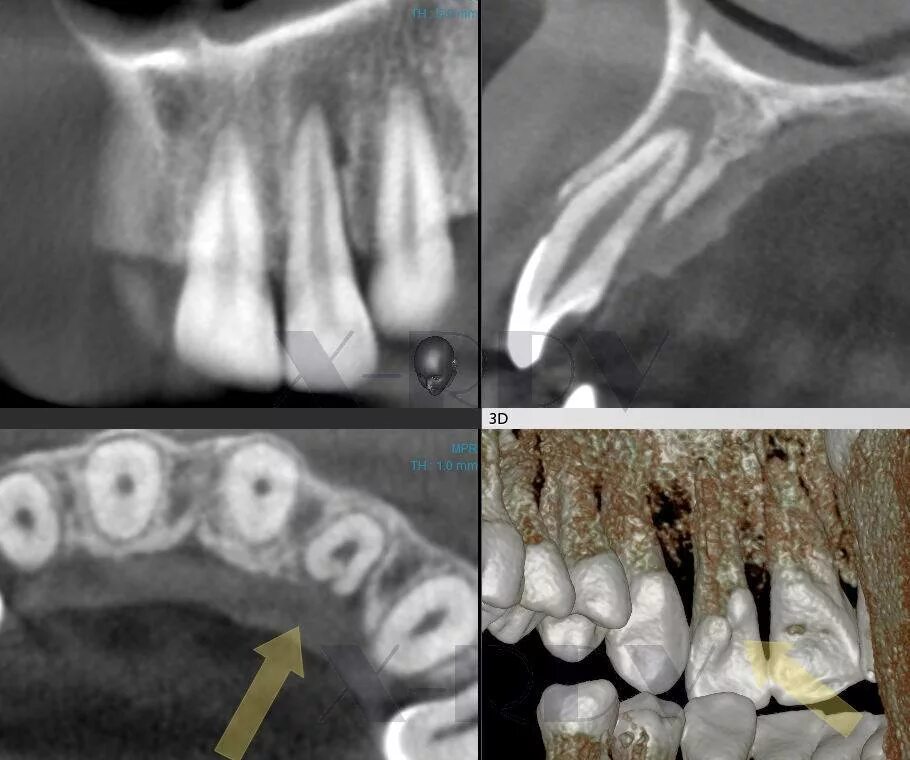 Снимок зубов видное. Кариес корня зуба рентген. Периодонтит зуба рентген. Периодонтит рентген челюсти.