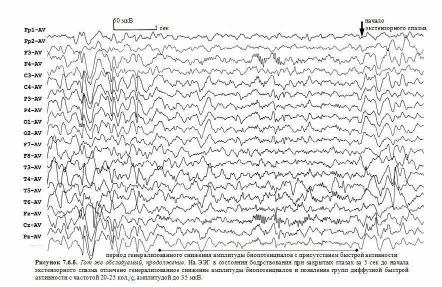 Изменения бэа головного мозга что это. Умеренная дезорганизация основного ритма на ЭЭГ. Диффузные изменения на ЭЭГ. Биоэлектрическая активность мозга. ЭЭГ биопотенциалы.